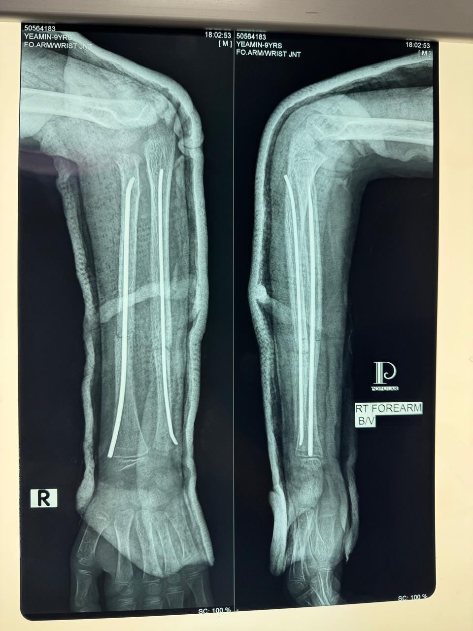 TENS in Fracture Shaft Of Radius Ulna