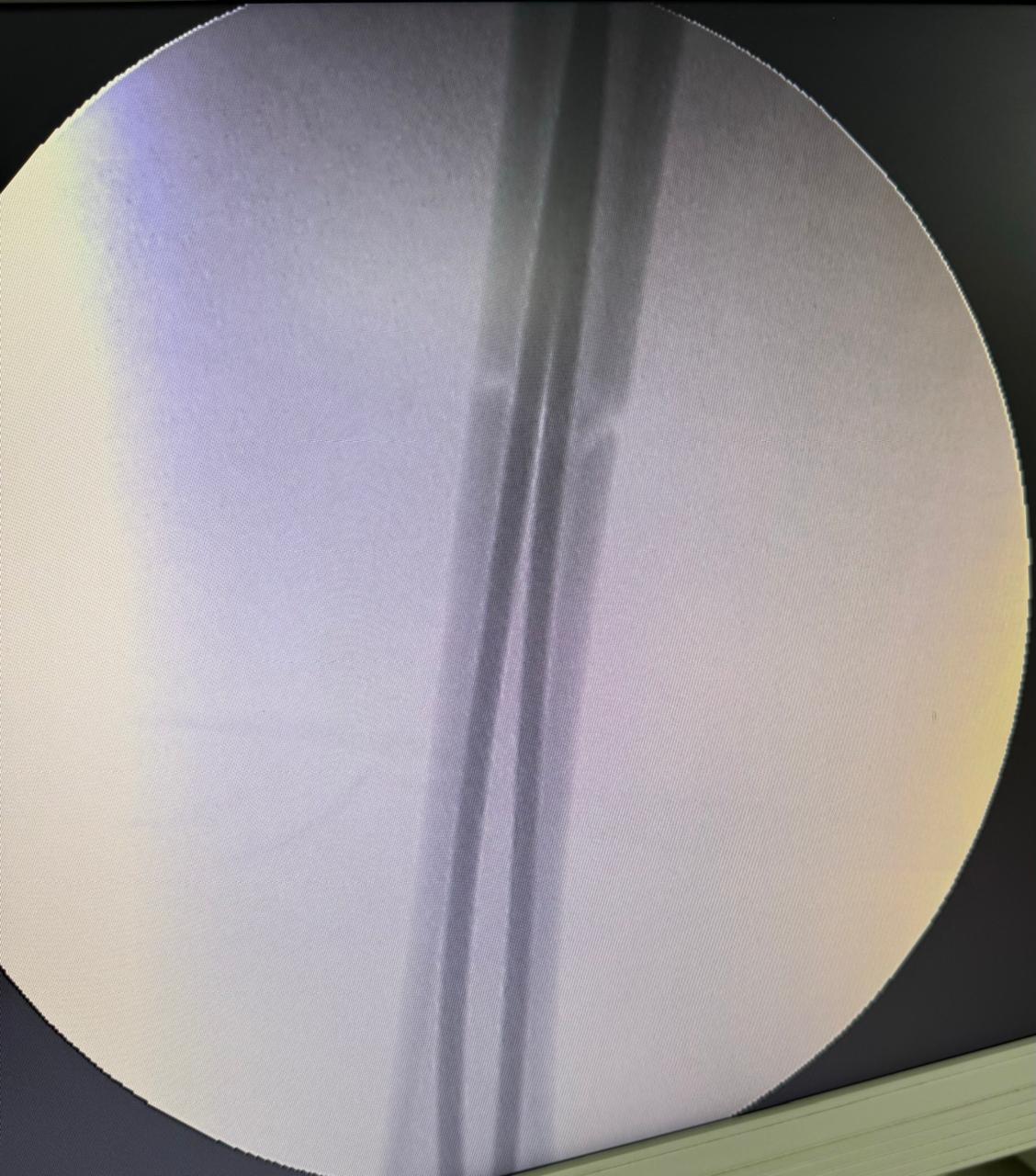 TENS In Fracture Shaft Of Femur