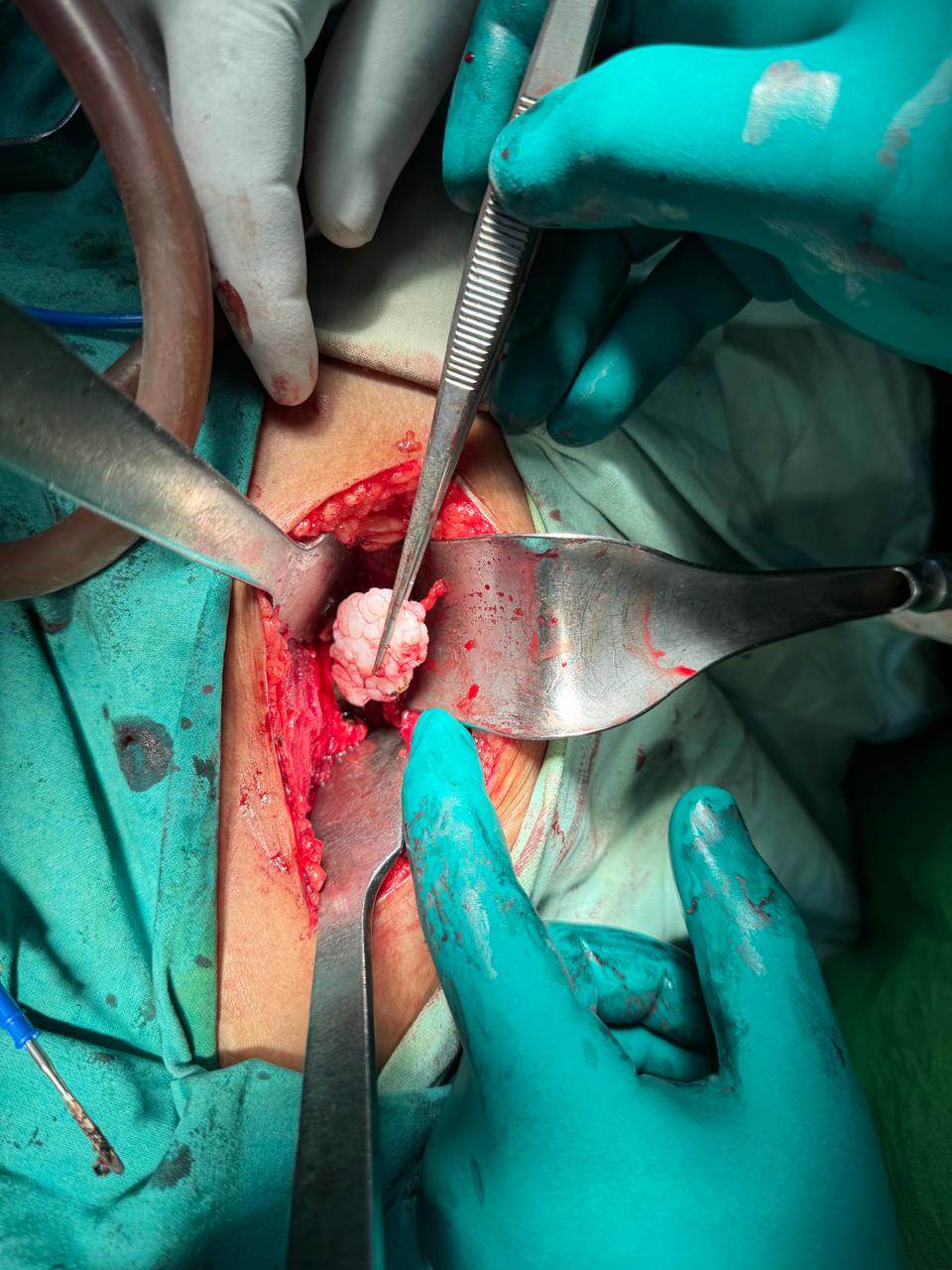 During Excision of Synovial Chondromatosis of hip joint