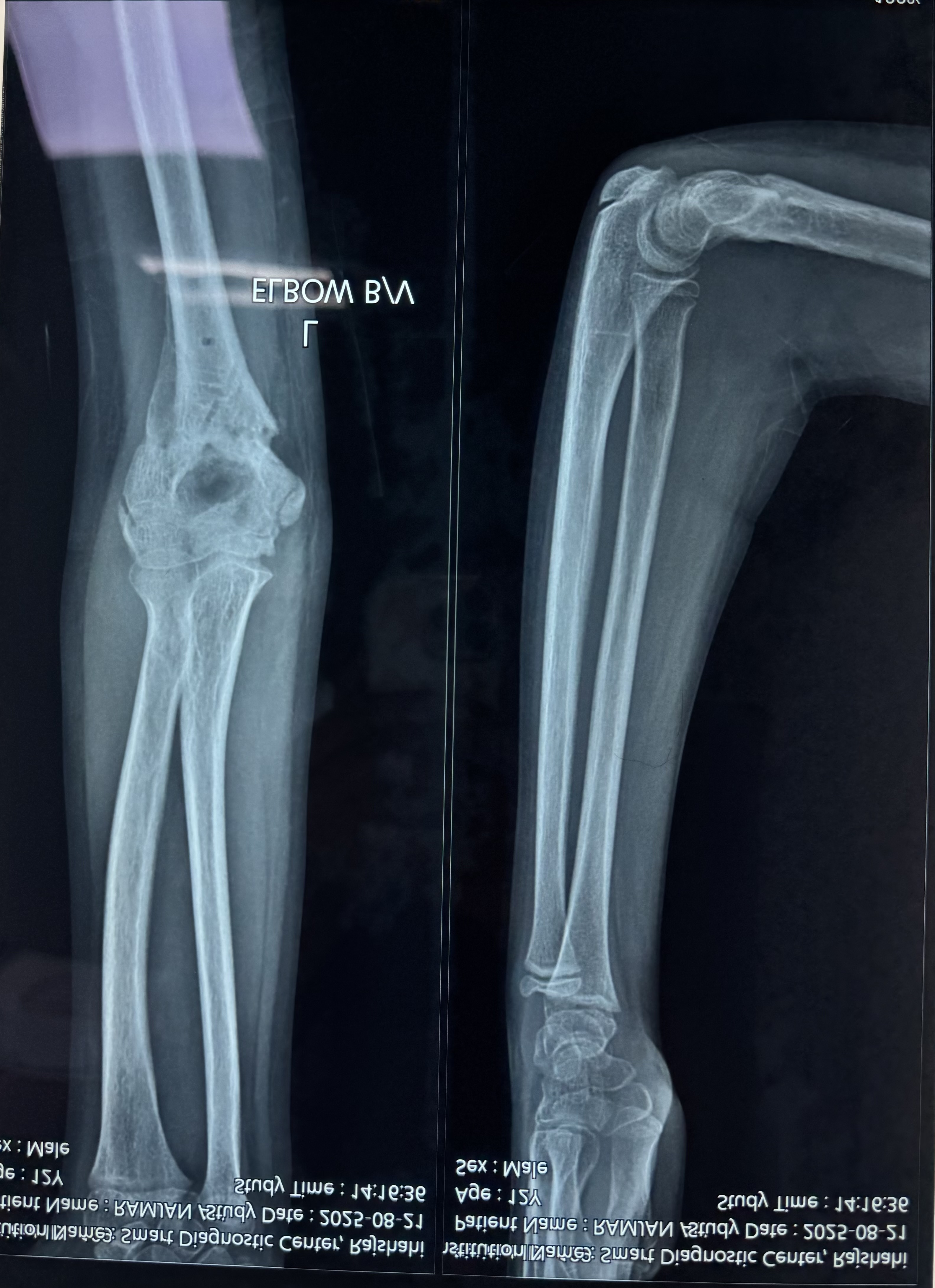 After 2 months of operation of Supracondylar fracture humerus