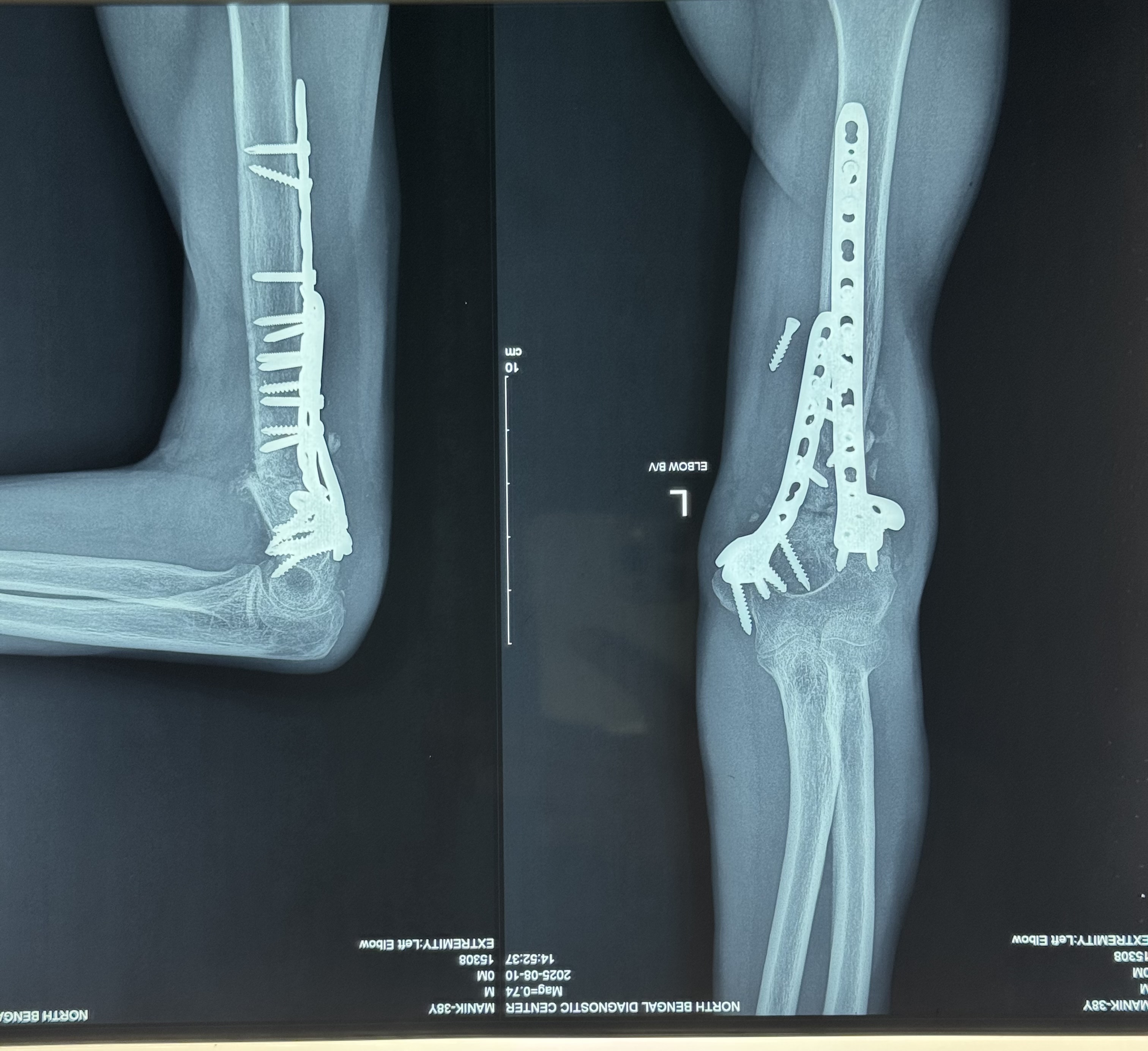 Fixation of 10 years old fracture nonunion Shaft of Humerus with history of three previous surgery