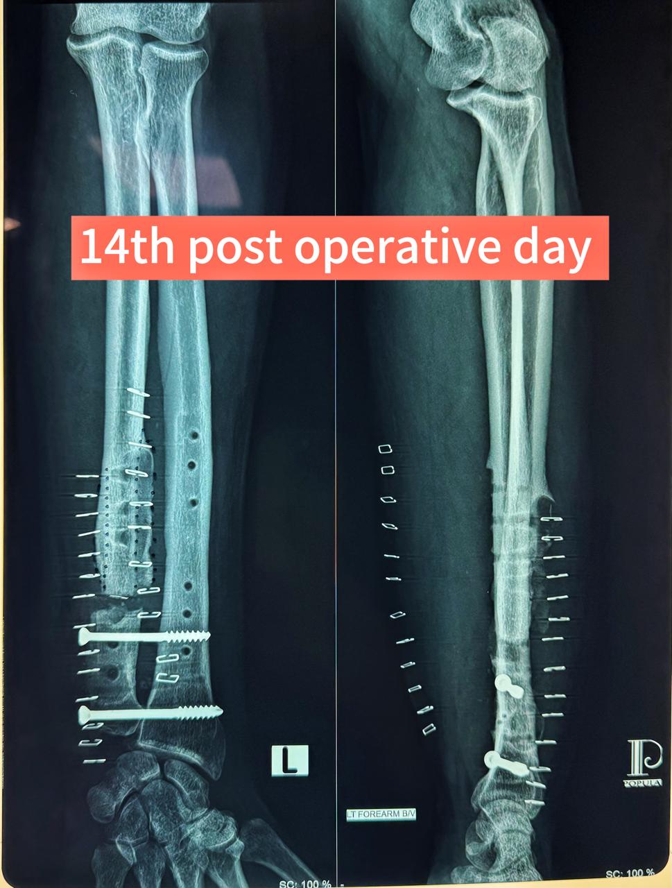 Removal of plate , refreshening of non union site of ulna, distal radio-ulnar K-wire fixation
