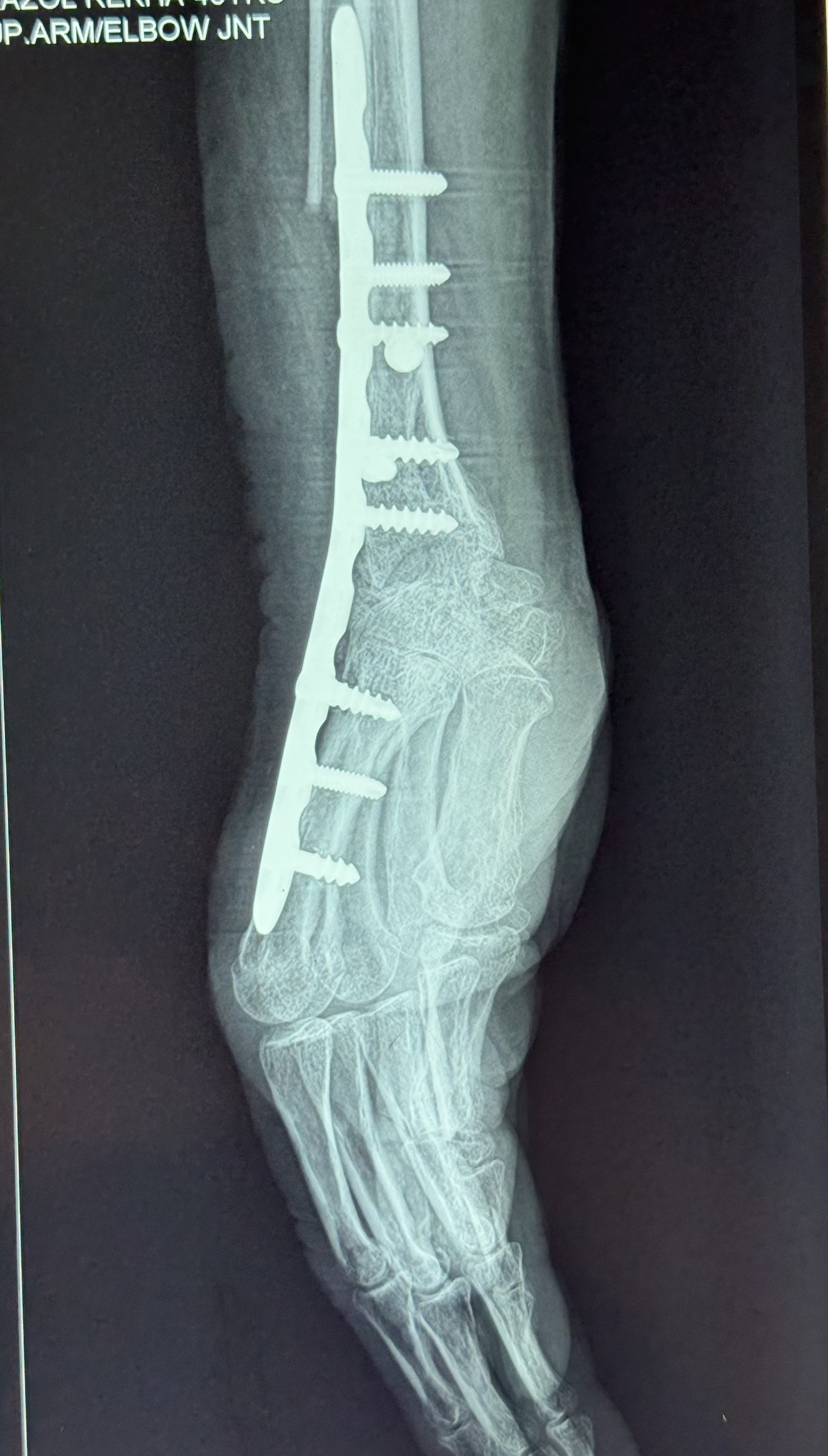 Arthrodesis of wrist in RA