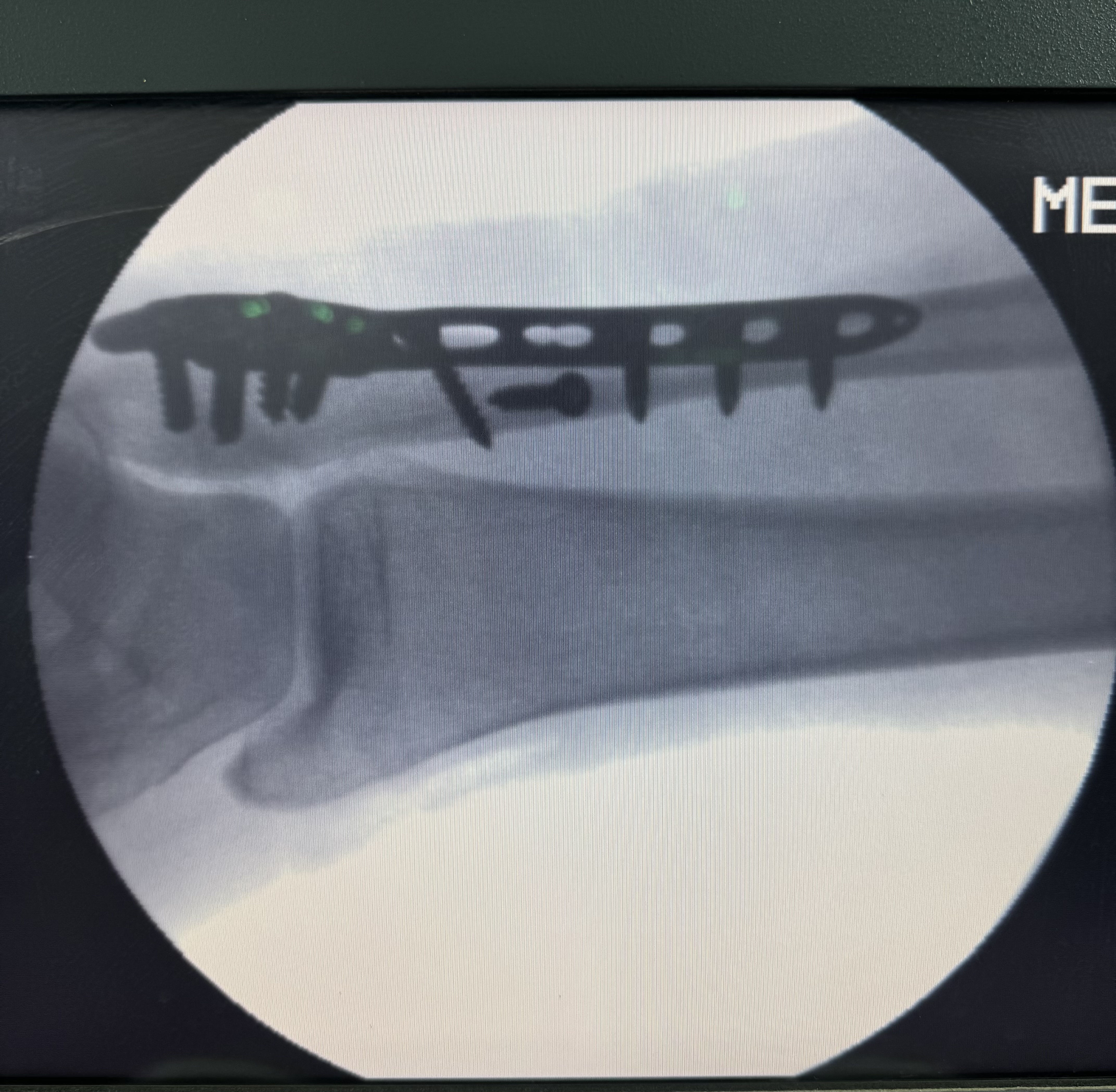 ORIF by Distal Fibular Locking Plate