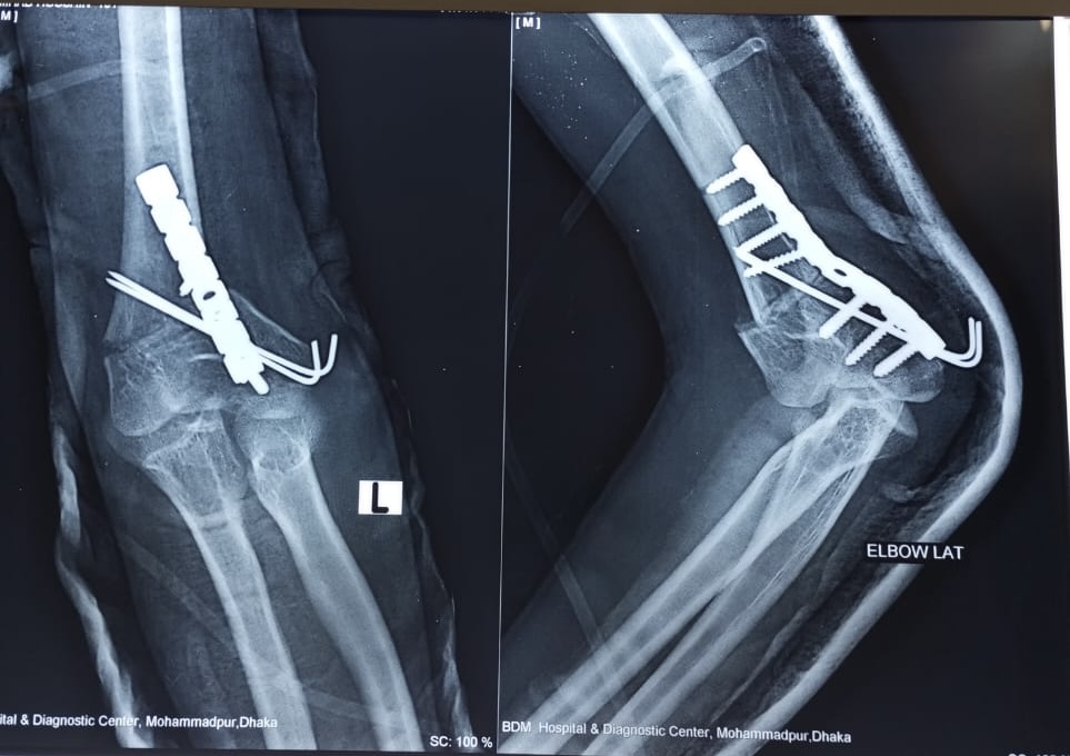 Corrective osteotomy in a cubitus varus deformity