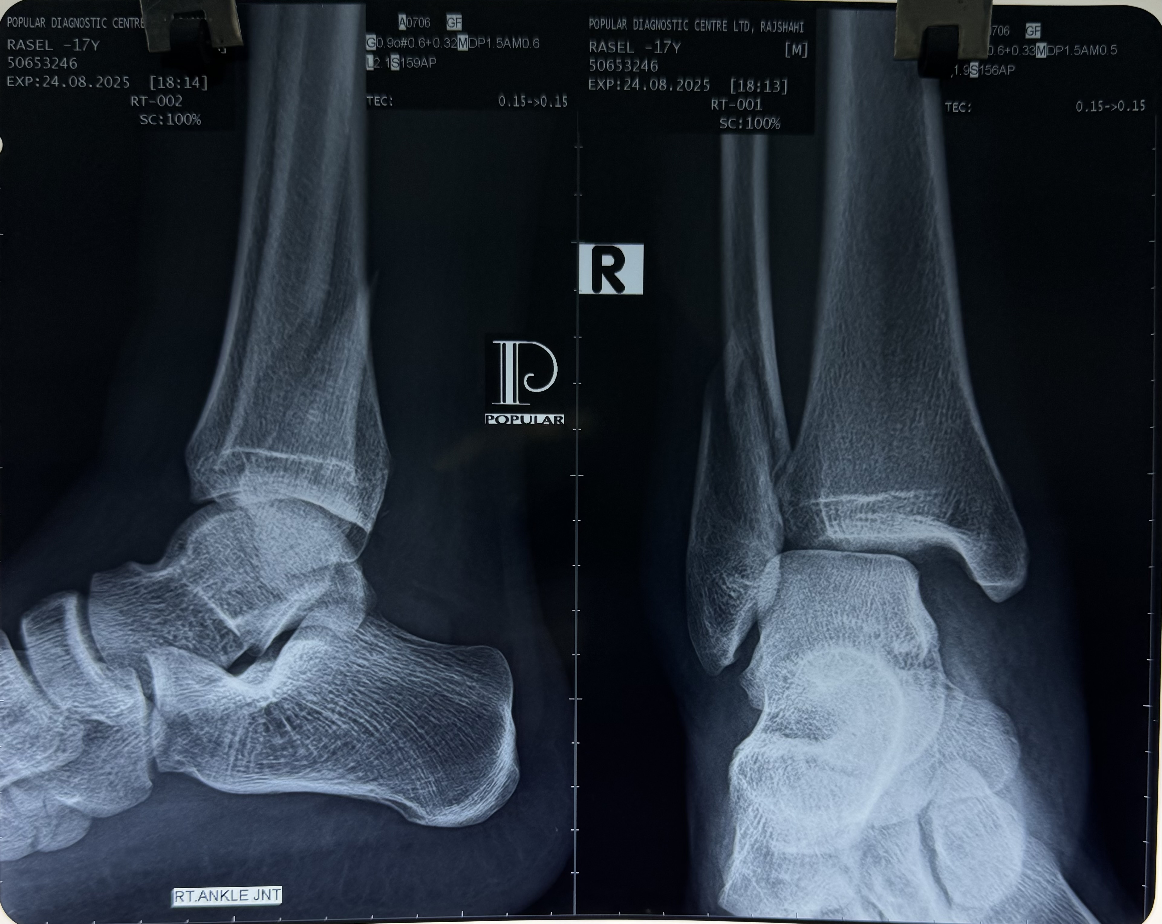 Closed Fracture Subluxation of Ankle joint
