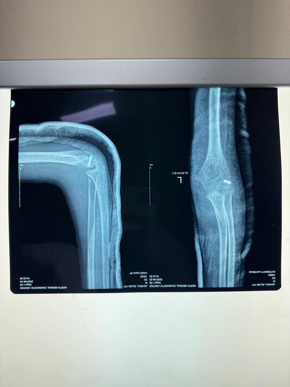 Fracture Capitellum Fixation By Herbert Screw