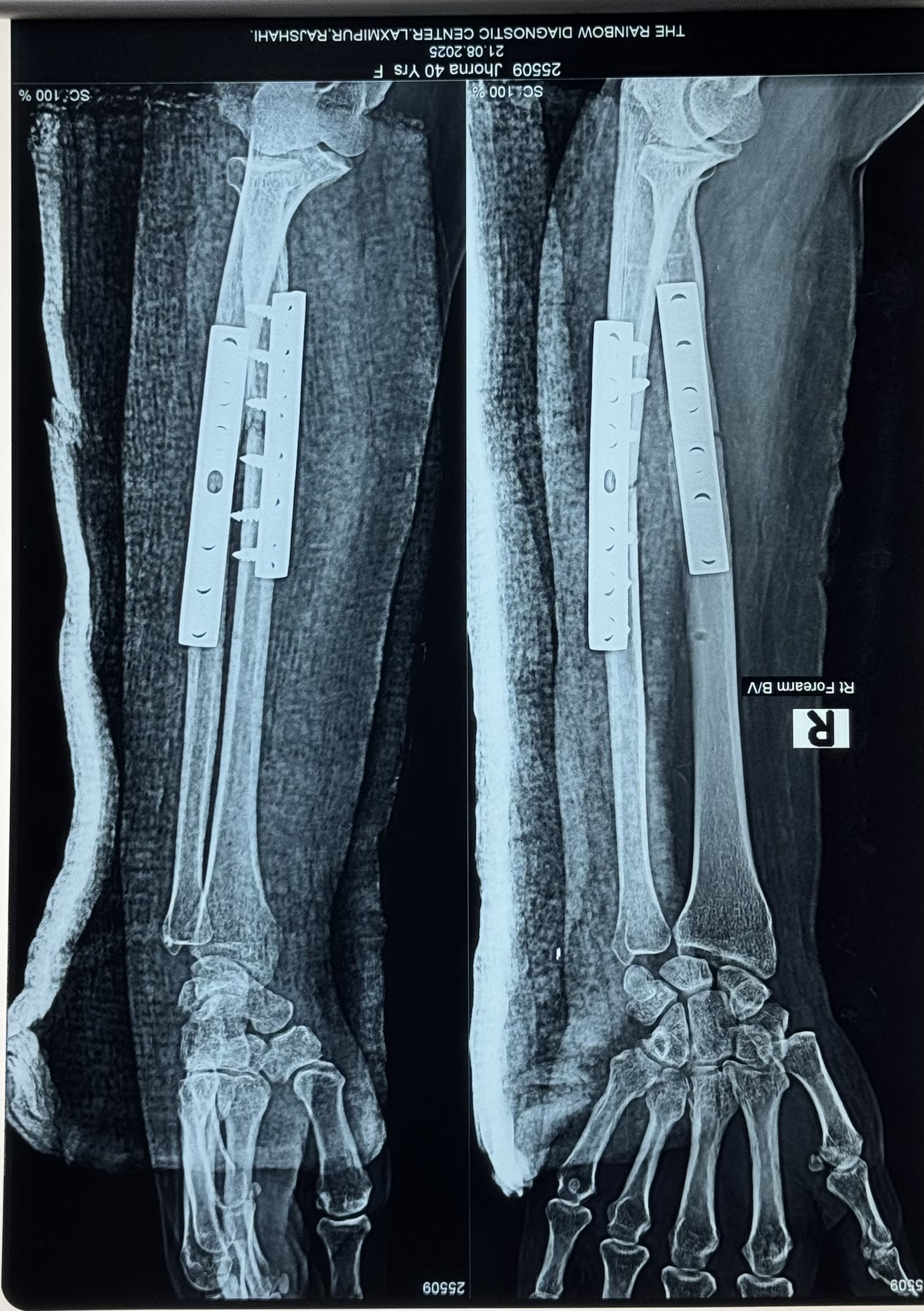 ORIF by Small DCP for Fracture Shaft of Radius Ulna