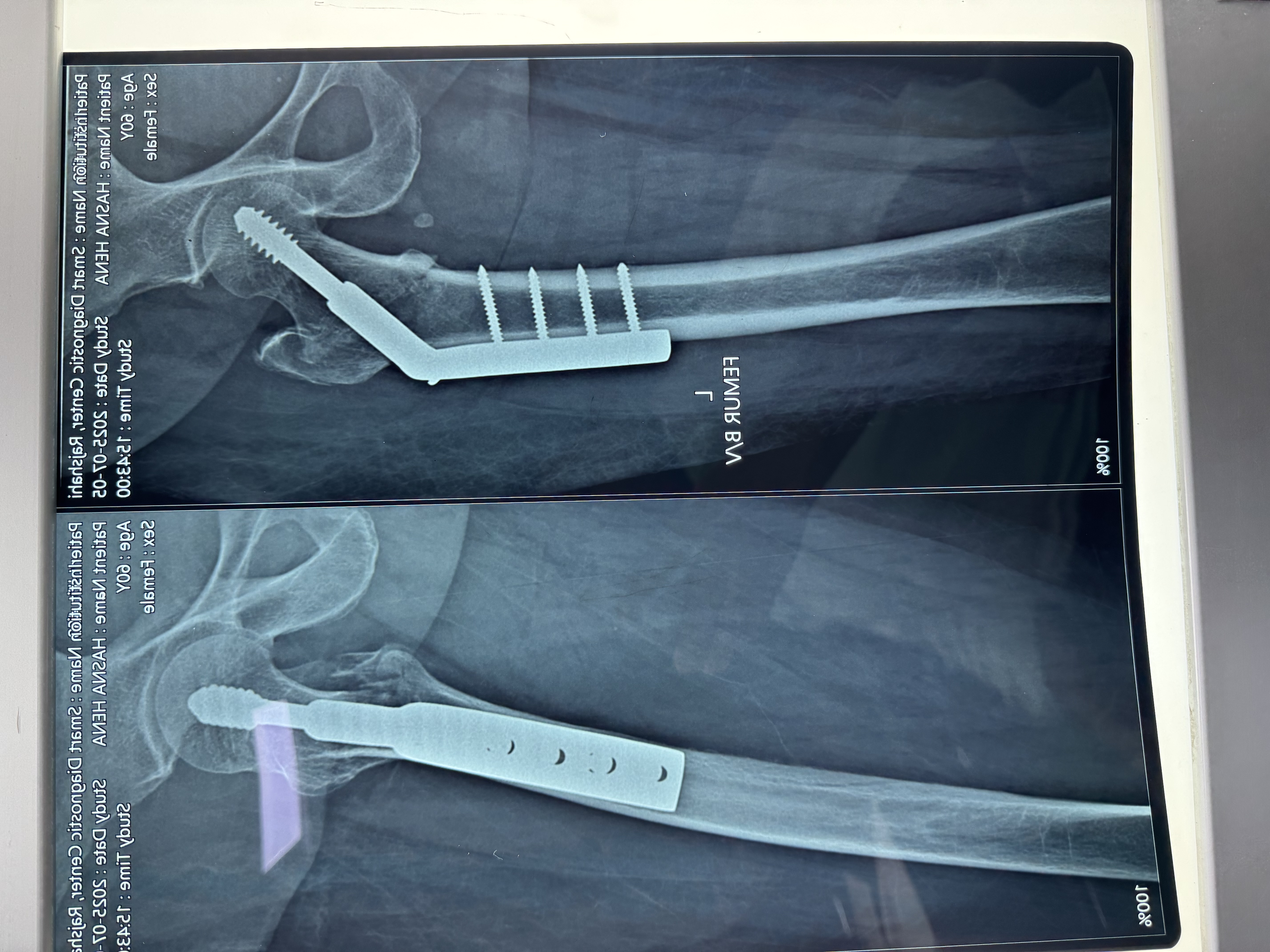 CRIF of intertrochanteric fracture by DHS