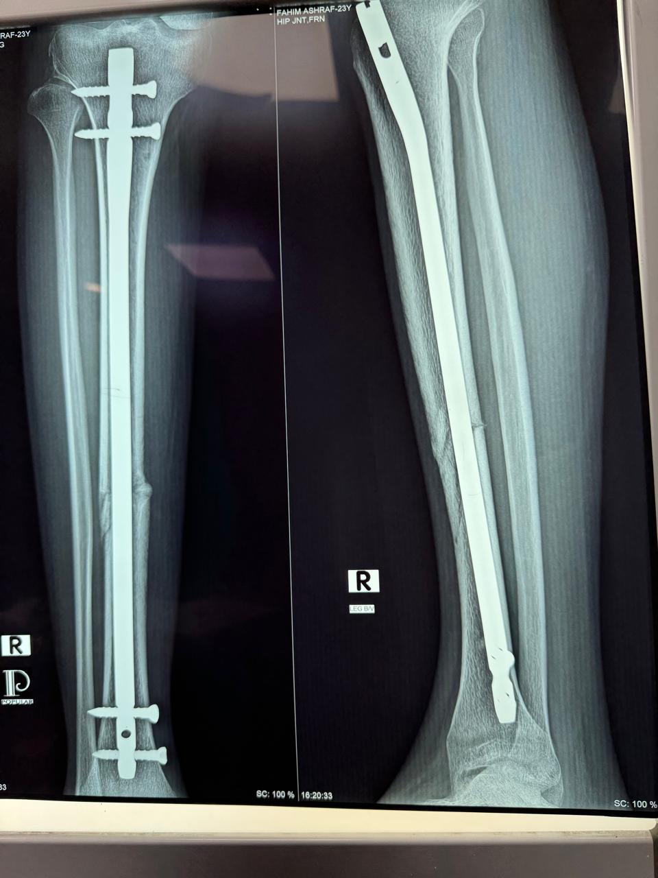Closed Reduction Internal Fixation