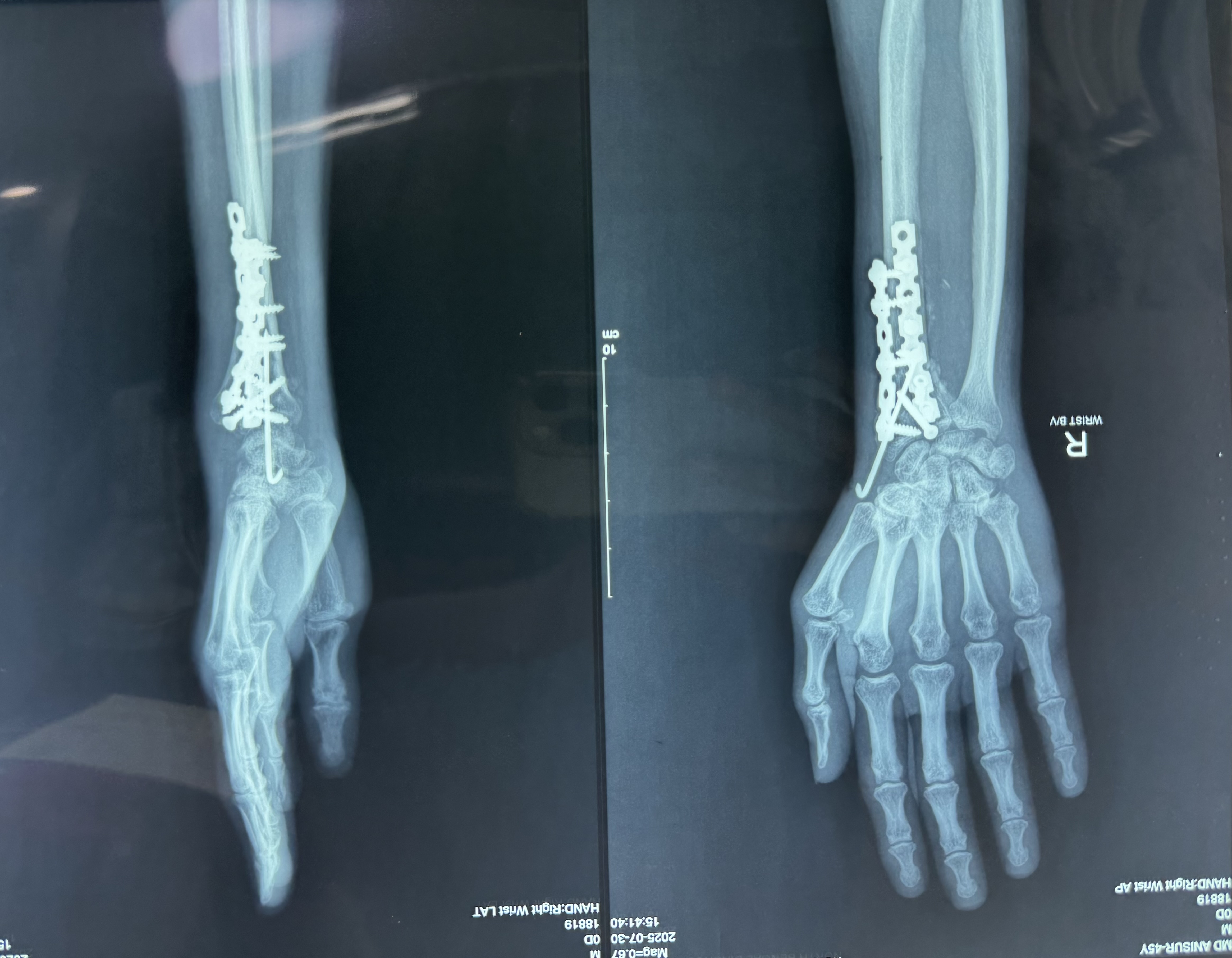 Dorsal plating in dorsal Barton fracture