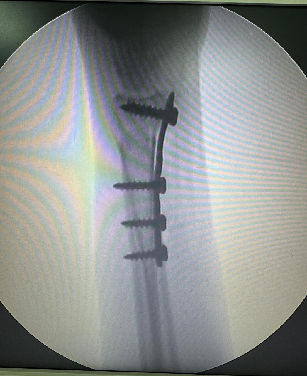 Fixation Of Distal Radius Fracture