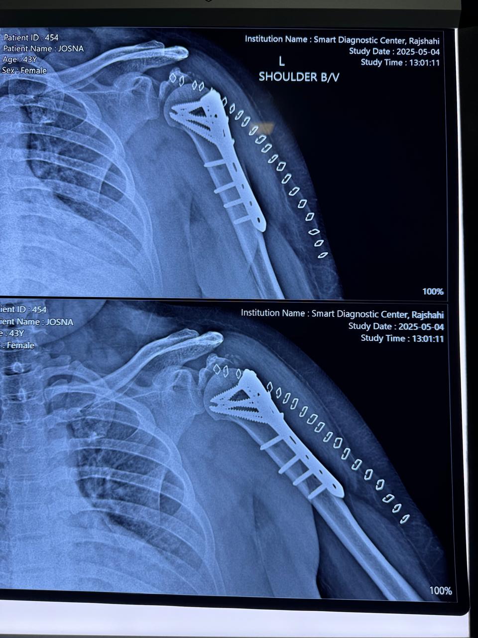 PHILOS Plating for Fracture Proximal Humerus