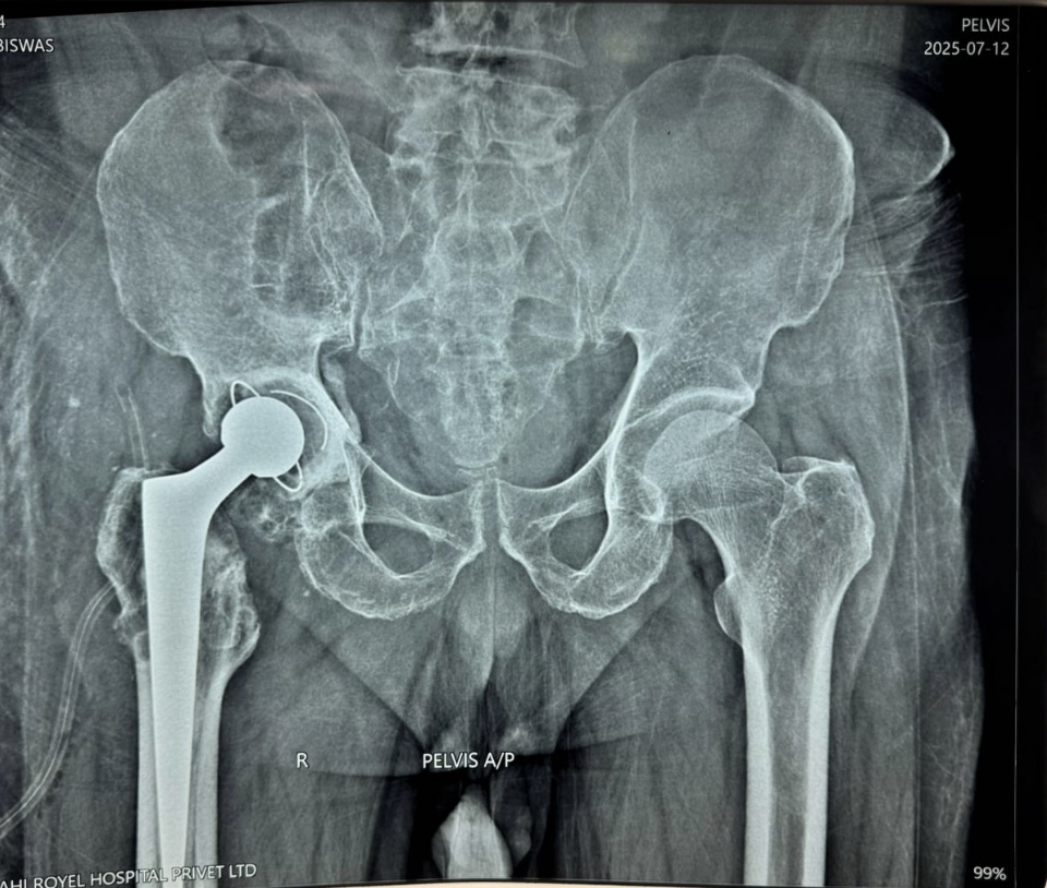 Total hip replacement surgery