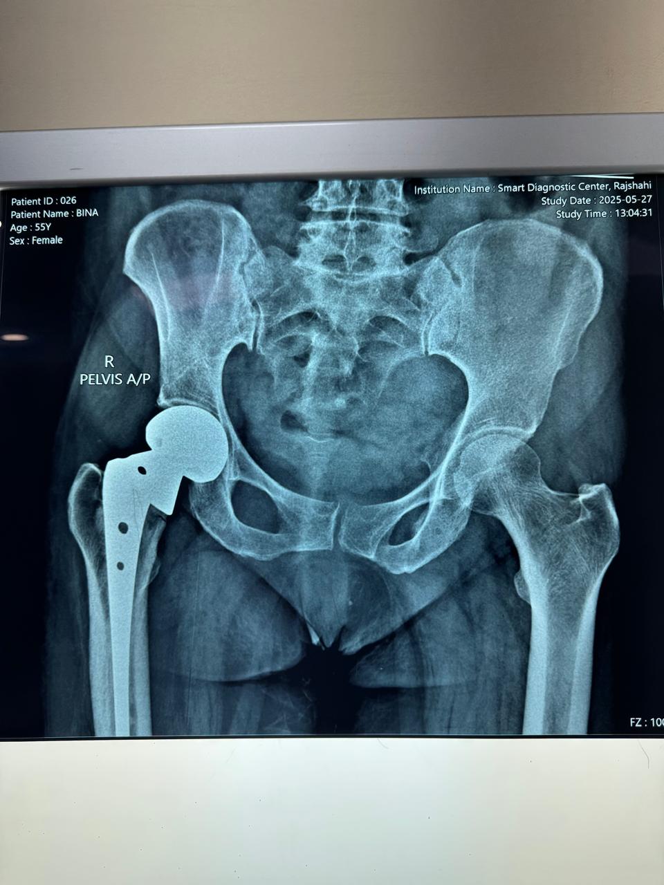 Hemiarthroplasty of Hip Joint
