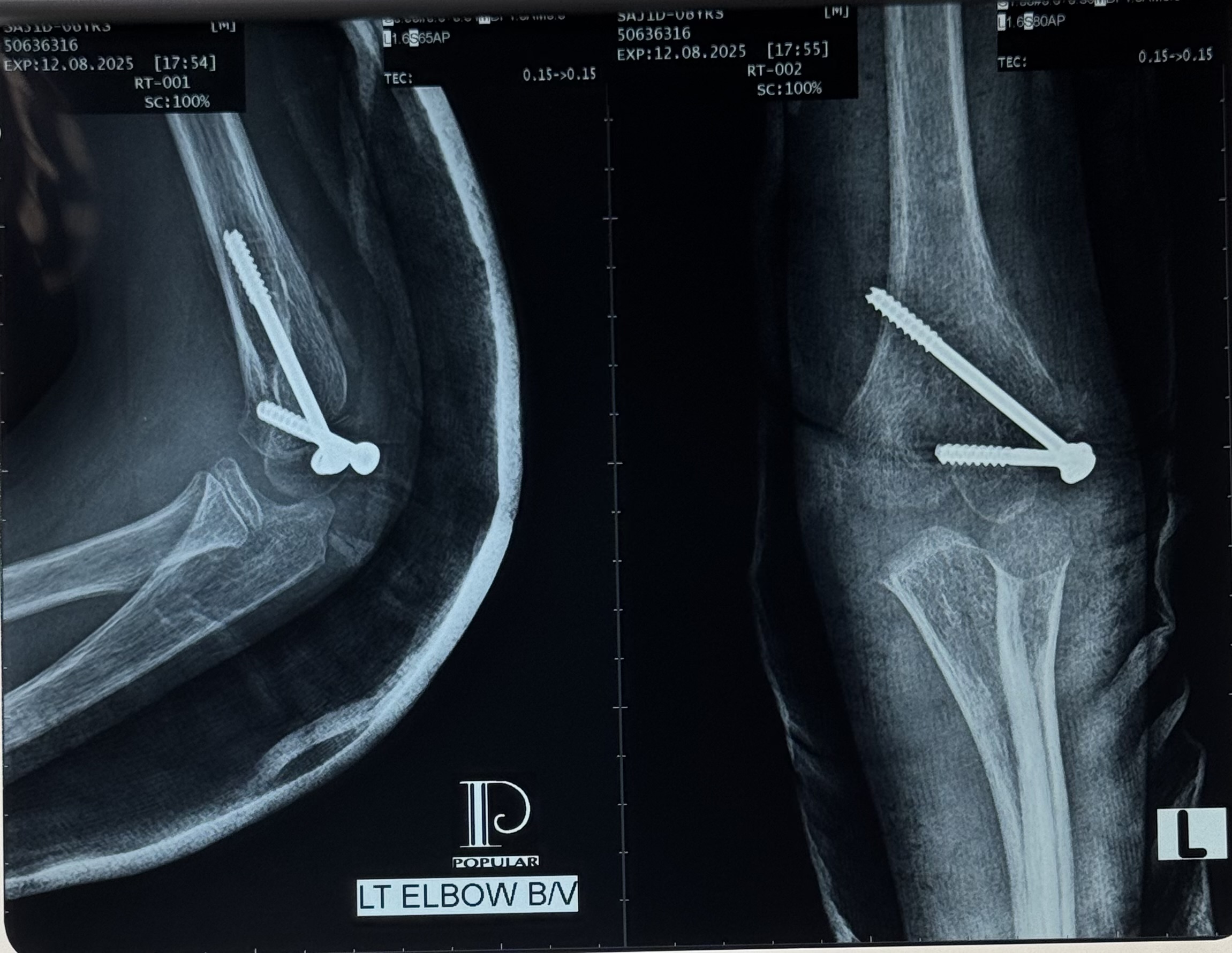 Fixation of one month old fracture lateral condyle