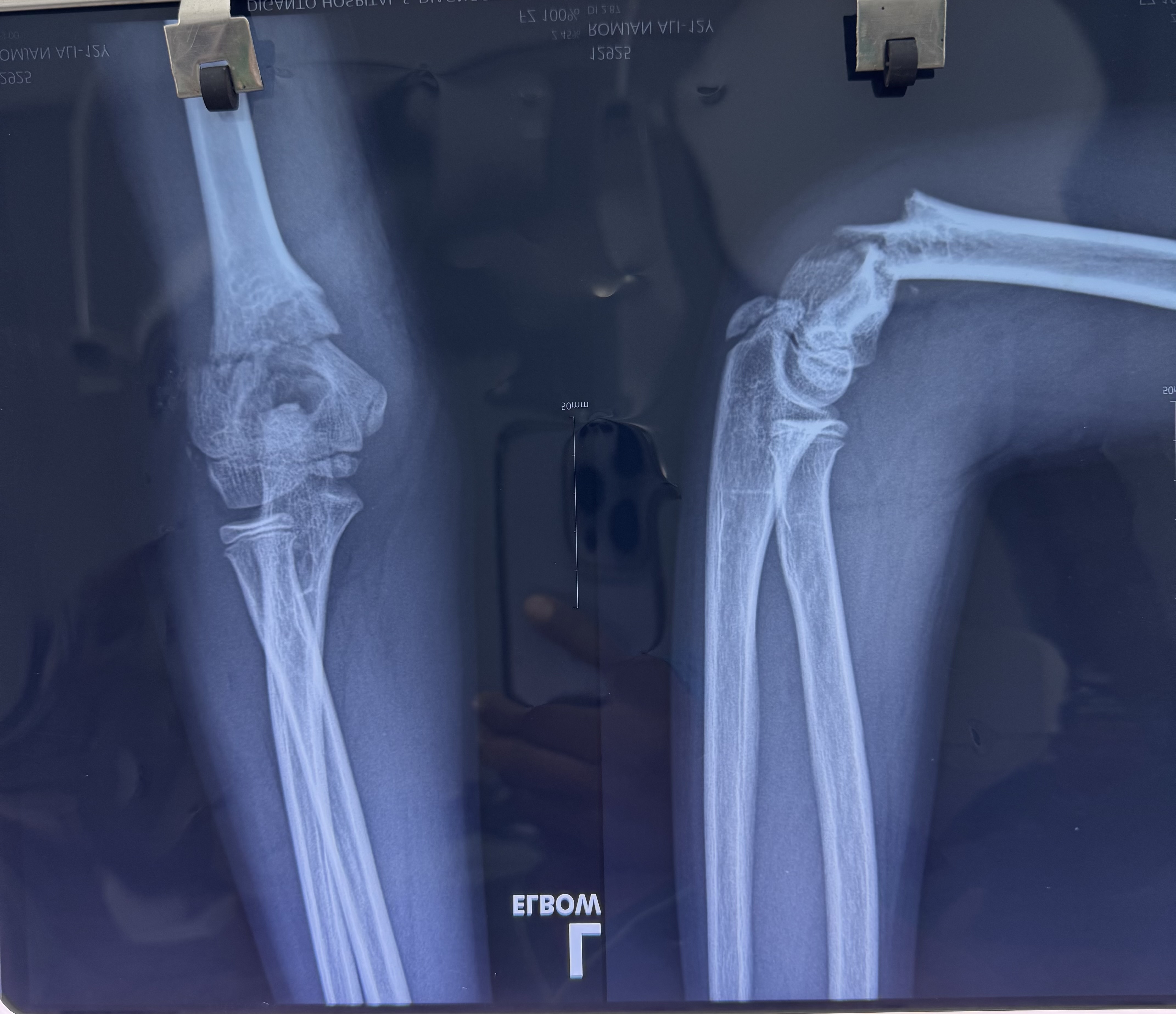 Before operation of Supracondylar fracture of humerus