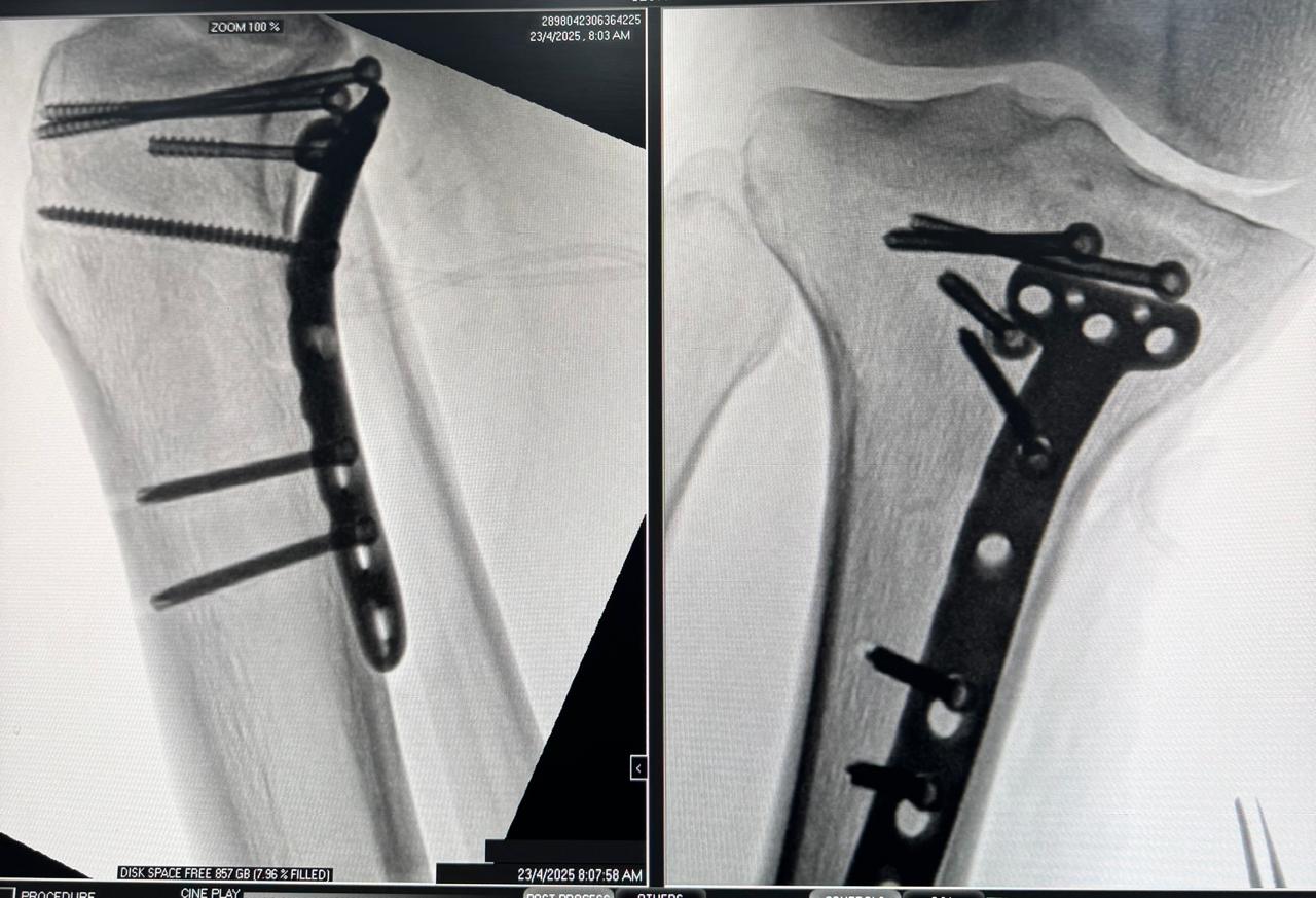 Fixation Of Tibial Plateau