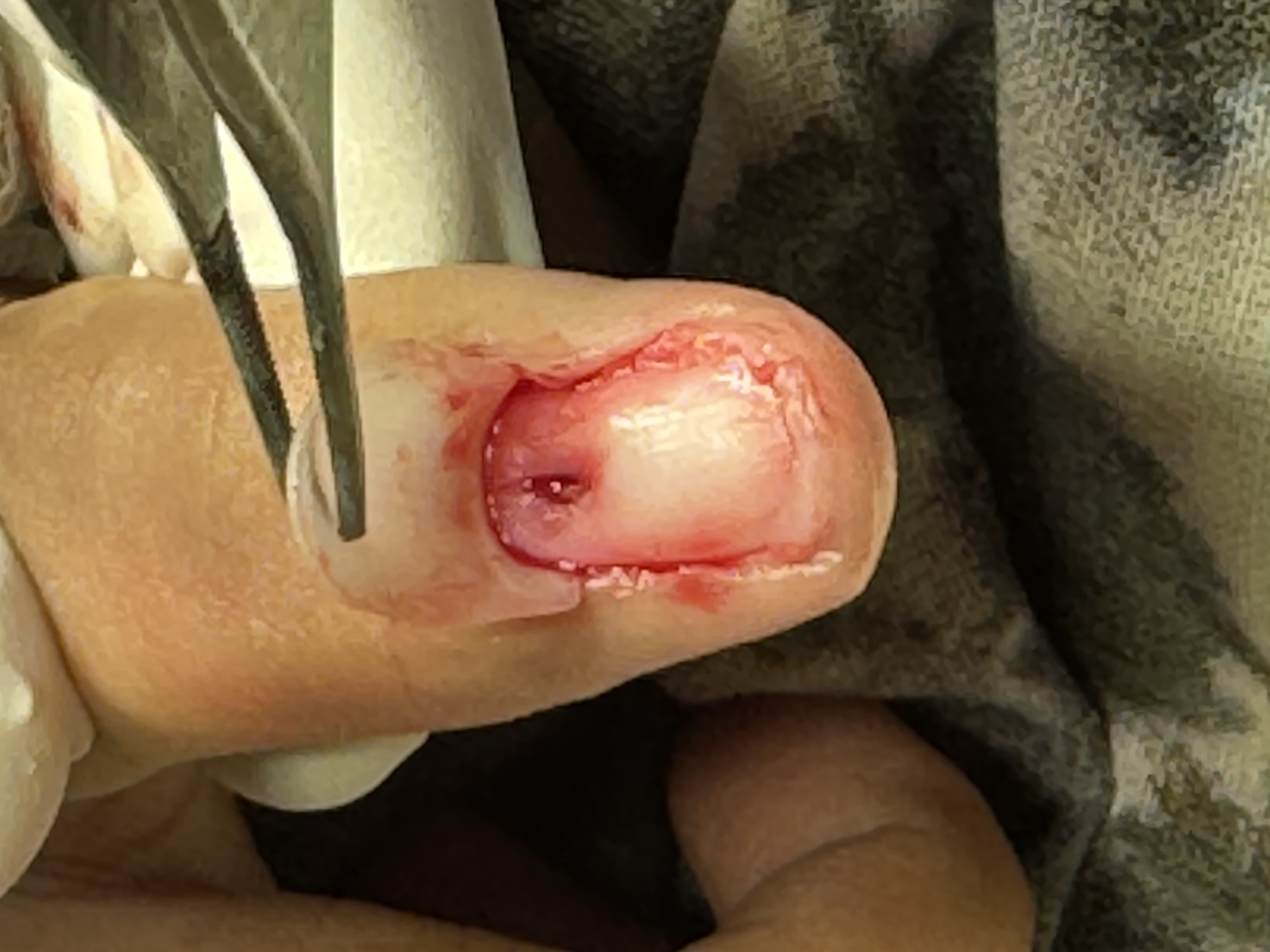 after excision of tumor nail was repositioned as a dressing