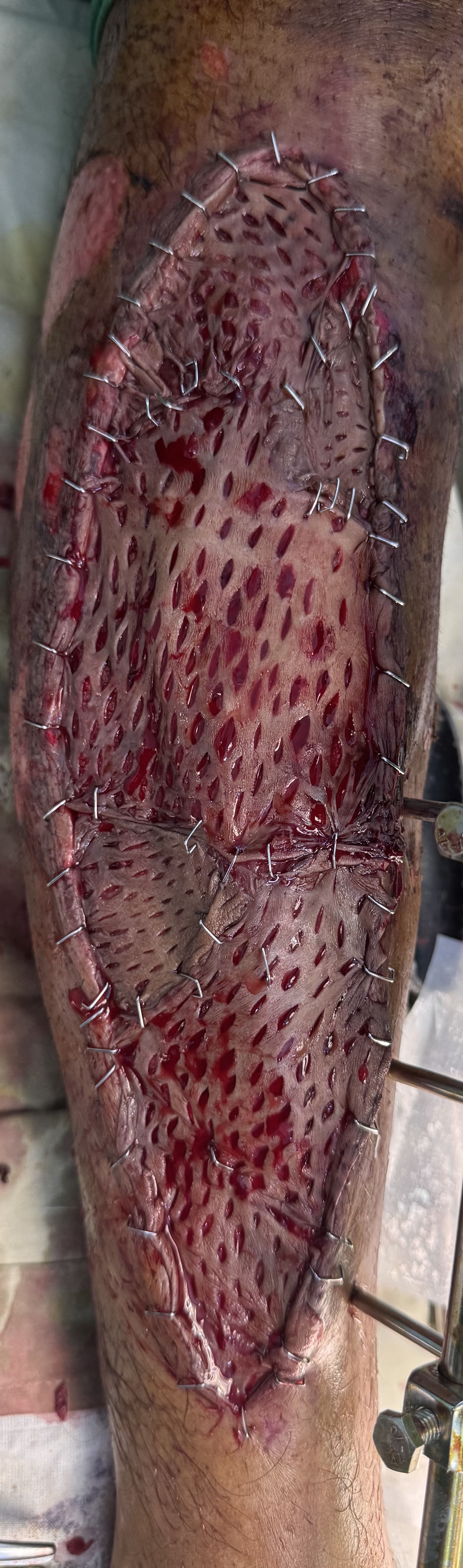 Skin Grafting over fasciotomy wound