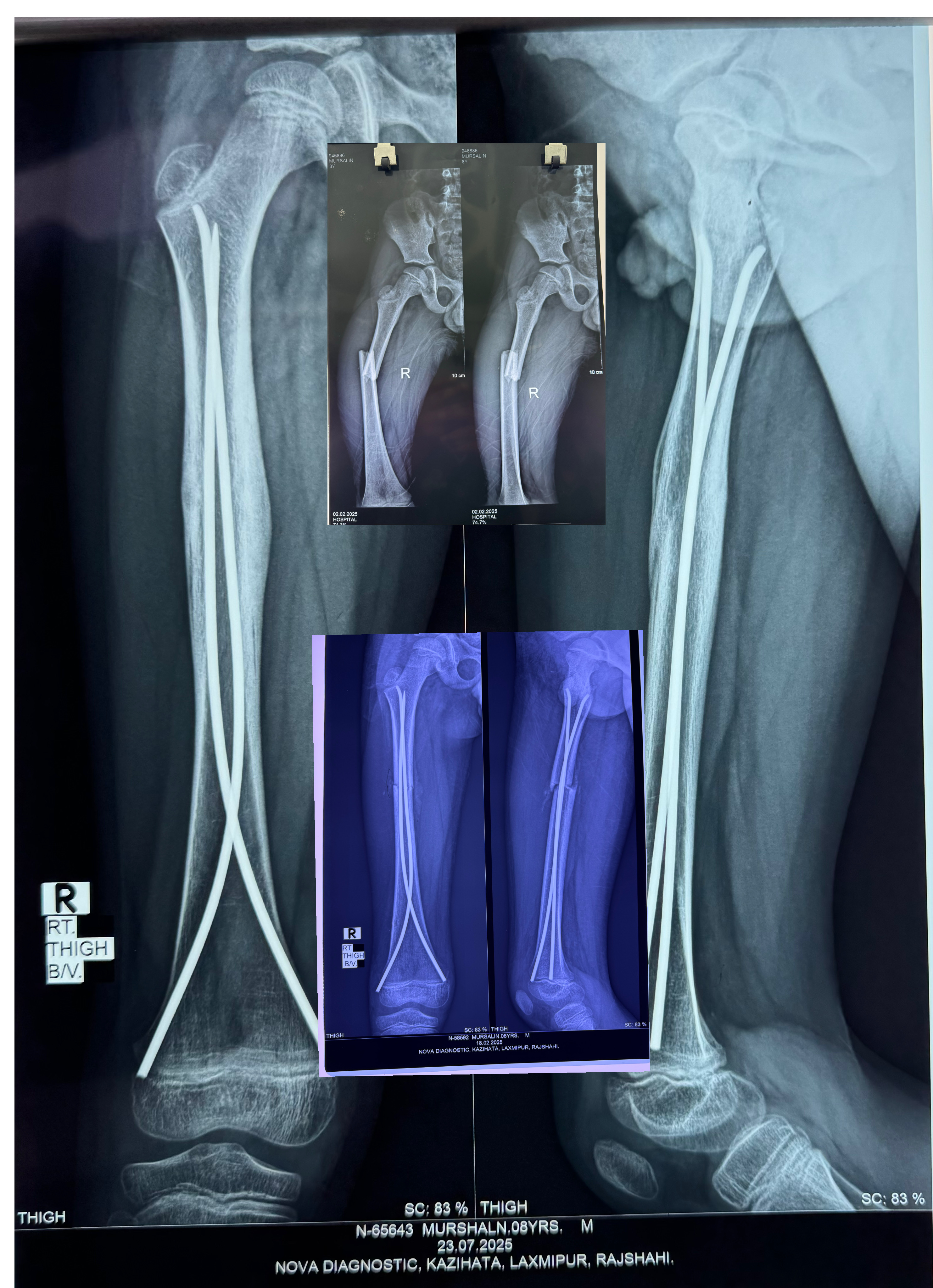 TENS in fracture shaft of femur